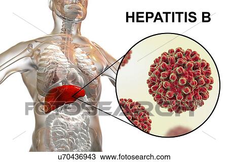 Stock Image - Hepatitis B infection. Computer illustration showing the liver and a close-up view of hepatitis B viruses.. Fotosearch