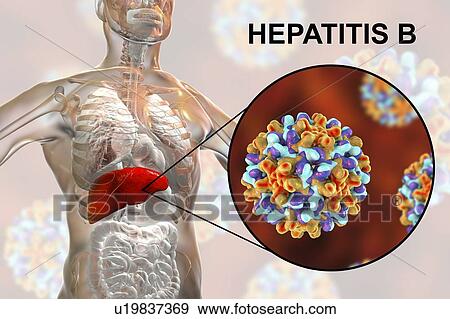 Stock Photo - Hepatitis B infection. Computer illustration showing the liver and a close-up view of hepatitis B viruses.. Fotosearch