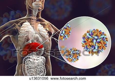 Stock Photograph - Hepatitis B infection. Computer illustration showing the liver and a close-up view of hepatitis B viruses.. Fotosearch