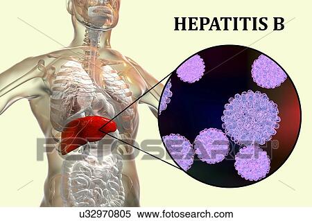 Stock Photography - Hepatitis B infection. Computer illustration showing the liver and a close-up view of hepatitis B viruses.. Fotosearch