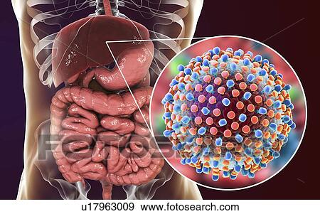 Stock Photo - Hepatitis C infection. Computer illustration showing liver and close-up view of hepatitis C viruses.. Fotosearch