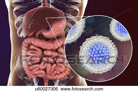 Stock Photograph - Hepatitis C infection. Computer illustration showing liver and close-up view of hepatitis C viruses.. Fotosearch
