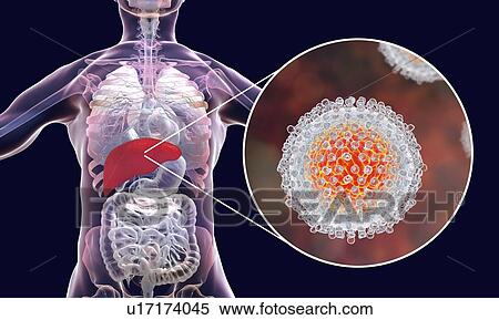 Stock Photography - Hepatitis C infection. Computer illustration showing the liver and a close-up view of hepatitis C viruses.. Fotosearch