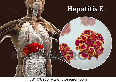 Stock Image - Hepatitis E infection. Computer illustration showing the liver and a close-up view of hepatitis E viruses.. Fotosearch