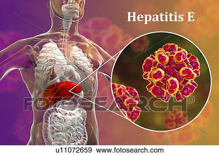 Stock Photo - Hepatitis E infection. Computer illustration showing the liver and a close-up view of hepatitis E viruses.. Fotosearch