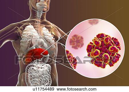 Stock Photo - Hepatitis E infection. Computer illustration showing the liver and a close-up view of hepatitis E viruses.. Fotosearch