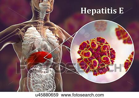 Stock Photo - Hepatitis E infection. Computer illustration showing the liver and a close-up view of hepatitis E viruses.. Fotosearch