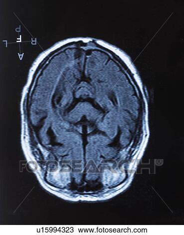 Human brain, magnetic resonance imaging (MRI) scan. View Large Photo Image Stock Image - Human brain, magnetic resonance imaging (MRI) scan.. Fotosearch