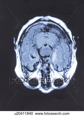 Stock Image - Human brain, magnetic resonance imaging (MRI) scan.. Fotosearch