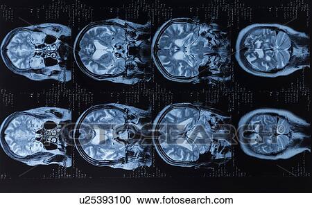 Human brain, magnetic resonance imaging (MRI) scans. View Large Photo Image Stock Image - Human brain, magnetic resonance imaging (MRI) scans.. Fotosearch