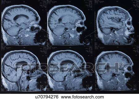Human brain, magnetic resonance imaging (MRI) scans. View Large Photo Image Stock Photograph - Human brain, magnetic resonance imaging (MRI) scans.. Fotosearch