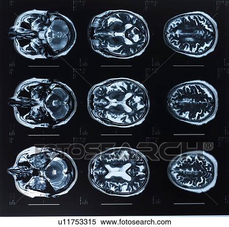 Stock Photography - Human brain, magnetic resonance imaging (MRI) scans.. Fotosearch