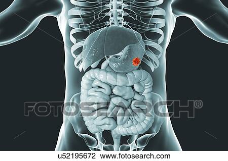 Stock Image - Human stomach cancer, computer illustration.. Fotosearch