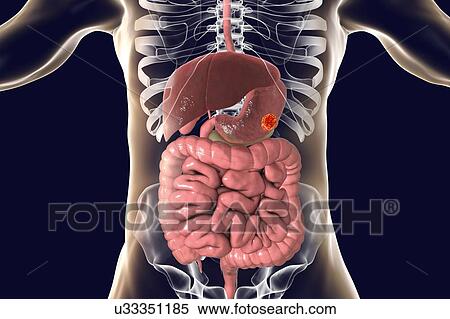 Stock Photography - Human stomach cancer, computer illustration.. Fotosearch