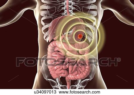Stock Image - Human stomach cancer treatment, conceptual computer illustration.. Fotosearch