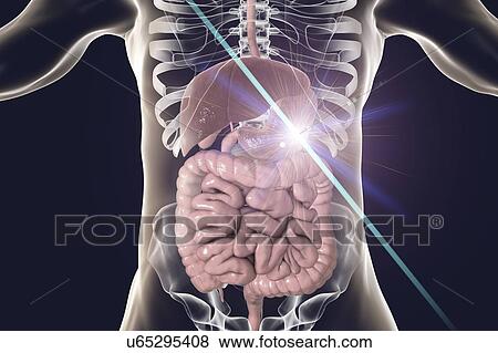 Human stomach cancer treatment, conceptual computer illustration. View Large Photo Image Stock Photo - Human stomach cancer treatment, conceptual computer illustration.. Fotosearch