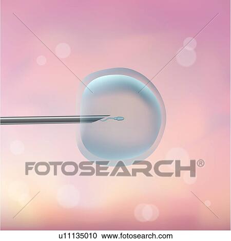 ICSI in vitro fertilisation. Illustration of a human egg cell (ovum, centre) being fertilised with a sperm cell (spermatozoon) through the process of intracytoplasmic sperm injection (ICSI). View Large Photo Image Stock Image - ICSI in vitro fertilisation. Illustration of a human egg cell (ovum, centre) being fertilised with a sperm cell (spermatozoon) through the process of intracytoplasmic sperm injection (ICSI).. Fotosearch