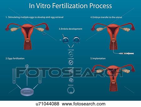 Stock Photo - In vitro fertilization (IVF) process, illustration.. Fotosearch