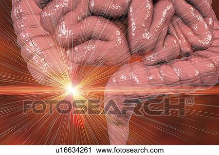 Stock Image - Laser appendectomy in acute appendicitis, conceptual computer illustration.. Fotosearch