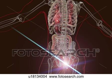 Picture - Laser treatment of haemorrhoids, conceptual computer illustration. Rear view of the human body with external haemorrhoids in the anus and removal of haemorrhoids by laser surgery.. Fotosearch