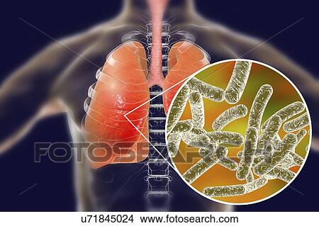 Legionnaires' disease, conceptual computer illustration. Legionella pneumophila bacteria are the cause of Legionnaires' disease. These bacilli (rod-shaped bacteria) are Gram-negative. L. pneumophila was identified as a pathogen after a mysterious... View Large Photo Image Picture - Legionnaires' disease, conceptual computer illustration. Legionella pneumophila bacteria are the cause of Legionnaires' disease. These bacilli (rod-shaped bacteria) are Gram-negative. L. pneumophila was identified as a pathogen after a mysterious.... Fotosearch