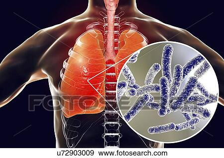 Stock Photo - Legionnaires' disease, conceptual computer illustration. Legionella pneumophila bacteria are the cause of Legionnaires' disease. These bacilli (rod-shaped bacteria) are Gram-negative. L. pneumophila was identified as a pathogen after a mysterious.... Fotosearch