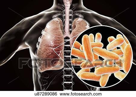 Stock Photograph - Legionnaires' disease, conceptual computer illustration. Legionella pneumophila bacteria are the cause of Legionnaires' disease. These bacilli (rod-shaped bacteria) are Gram-negative. L. pneumophila was identified as a pathogen after a mysterious.... Fotosearch