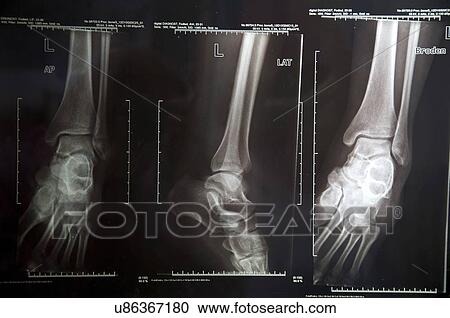 Stock Image - Lower leg X-rays.. Fotosearch