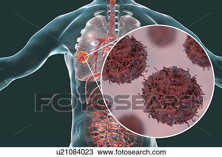 Stock Image - Lung cancer. Computer illustration showing a cancerous tumour in the lung and a close-up view of lung cancer cells.. Fotosearch