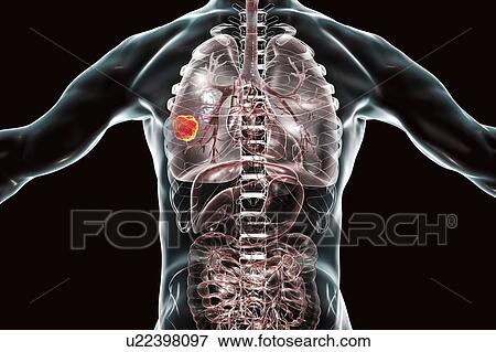 Stock Photo - Lung cancer, computer illustration.. Fotosearch