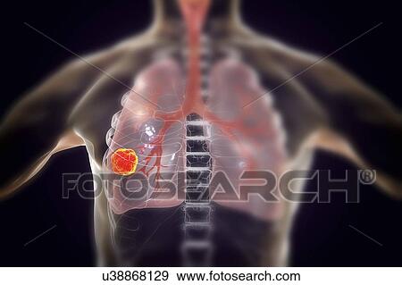 Stock Photo - Lung cancer, computer illustration.. Fotosearch