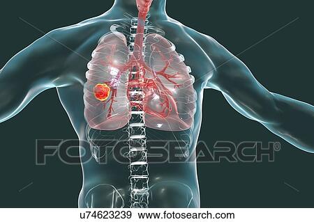 Stock Photo - Lung cancer, computer illustration.. Fotosearch
