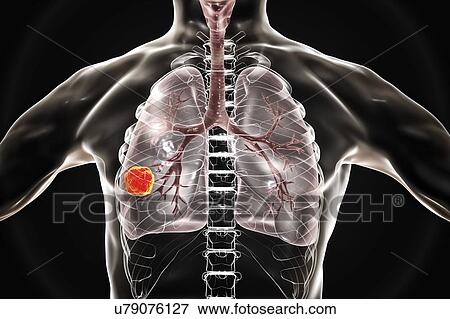 Stock Photo - Lung cancer, computer illustration.. Fotosearch