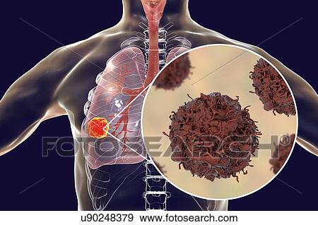 Lung cancer. Computer illustration showing a cancerous tumour in the lung and a close-up view of lung cancer cells. View Large Photo Image Stock Photo - Lung cancer. Computer illustration showing a cancerous tumour in the lung and a close-up view of lung cancer cells.. Fotosearch