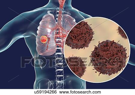 Lung cancer. Computer illustration showing a cancerous tumour in the lung and a close-up view of lung cancer cells. View Large Photo Image Stock Photograph - Lung cancer. Computer illustration showing a cancerous tumour in the lung and a close-up view of lung cancer cells.. Fotosearch