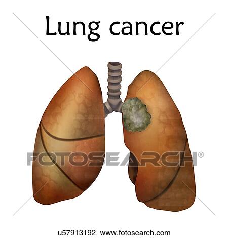 Stock Image - Lung cancer, illustration.. Fotosearch