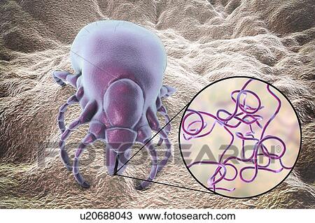 Lyme disease tick, illustration. Ticks (superfamily Ixodoidea) are external parasites that feed on human and animal blood. Their bite can transmit a number of diseases including Lyme disease, which is caused by the bacterium Borrelia burgdorferi. View Large Photo Image Stock Image - Lyme disease tick, illustration. Ticks (superfamily Ixodoidea) are external parasites that feed on human and animal blood. Their bite can transmit a number of diseases including Lyme disease, which is caused by the bacterium Borrelia burgdorferi.. Fotosearch