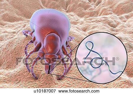 Stock Photo - Lyme disease tick, illustration. Ticks (superfamily Ixodoidea) are external parasites that feed on human and animal blood. Their bite can transmit a number of diseases including Lyme disease, which is caused by the bacterium Borrelia burgdorferi.. Fotosearch