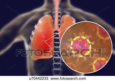 MERS virus infection of lungs, conceptual illustration. MERS (Middle East respiratory syndrome) is a viral respiratory illness caused by the MERS-associated coronavirus (MERS-CoV). Formerly known as novel coronavirus, MERS was first identified in... View Large Photo Image Stock Image - MERS virus infection of lungs, conceptual illustration. MERS (Middle East respiratory syndrome) is a viral respiratory illness caused by the MERS-associated coronavirus (MERS-CoV). Formerly known as novel coronavirus, MERS was first identified in.... Fotosearch