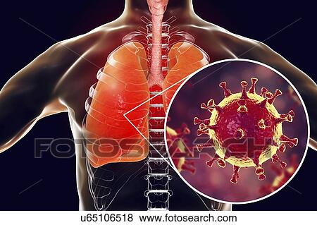 MERS virus infection of lungs, conceptual illustration. MERS (Middle East respiratory syndrome) is a viral respiratory illness caused by the MERS-associated coronavirus (MERS-CoV). Formerly known as novel coronavirus, MERS was first identified in... View Large Photo Image Stock Photo - MERS virus infection of lungs, conceptual illustration. MERS (Middle East respiratory syndrome) is a viral respiratory illness caused by the MERS-associated coronavirus (MERS-CoV). Formerly known as novel coronavirus, MERS was first identified in.... Fotosearch