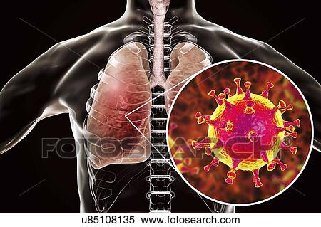 MERS virus infection of lungs, conceptual illustration. MERS (Middle East respiratory syndrome) is a viral respiratory illness caused by the MERS-associated coronavirus (MERS-CoV). Formerly known as novel coronavirus, MERS was first identified in... View Large Photo Image Stock Photography - MERS virus infection of lungs, conceptual illustration. MERS (Middle East respiratory syndrome) is a viral respiratory illness caused by the MERS-associated coronavirus (MERS-CoV). Formerly known as novel coronavirus, MERS was first identified in.... Fotosearch