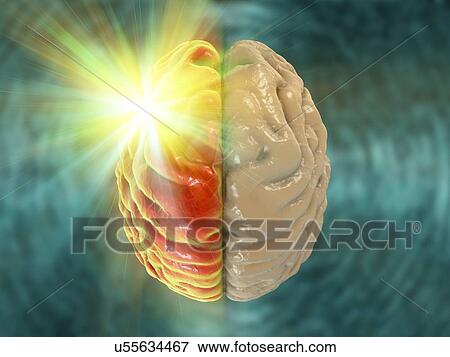 Migraine, conceptual computer illustration. View Large Photo Image Stock Photo - Migraine, conceptual computer illustration.. Fotosearch
