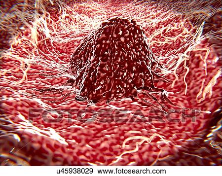 Migrating cancer cell. Illustration of a cancer cell in a blood vessel or lymph node, with numerous filipodia (thread-like processes) at its leading edge. These features are characteristic of highly mobile cells, and enable cancerous cells to spread... View Large Photo Image Stock Photo - Migrating cancer cell. Illustration of a cancer cell in a blood vessel or lymph node, with numerous filipodia (thread-like processes) at its leading edge. These features are characteristic of highly mobile cells, and enable cancerous cells to spread.... Fotosearch