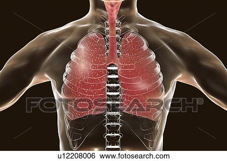 Stock Photograph - Miliary tuberculosis, computer illustration. Miliary tuberculosis is a result of hematogenous dissemination of Mycobacterium tuberculosis bacteria producing myriads of small tuberculosis granulomatous lesions through the lung or the whole body.. Fotosearch