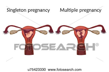 Stock Image - Multiple and singleton pregnancy comparison, illustration. Fotosearch