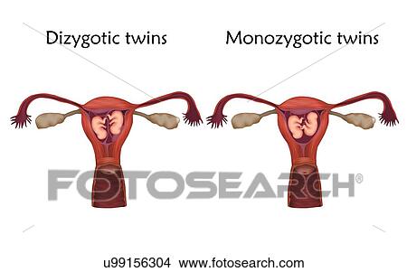 Multiple pregnancy, illustration. Dizygotic and monozygotic twins comparison. View Large Photo Image Picture - Multiple pregnancy, illustration. Dizygotic and monozygotic twins comparison.. Fotosearch