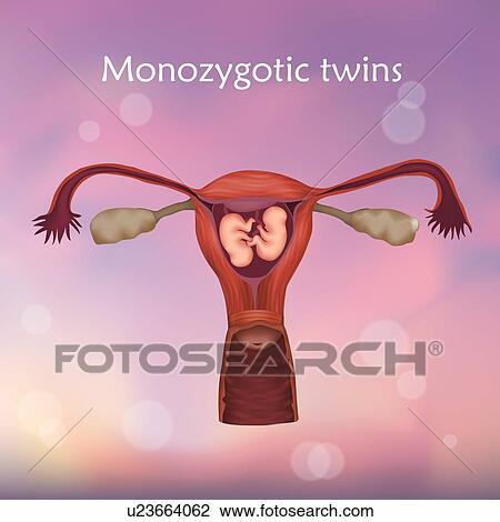 Stock Image - Multiple pregnancy, illustration. Monozygotic twins in the uterus sharing the same placenta.. Fotosearch
