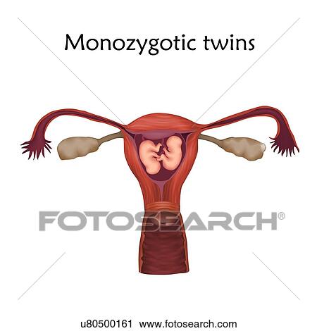 Stock Image - Multiple pregnancy, illustration. Monozygotic twins in the uterus sharing the same placenta.. Fotosearch