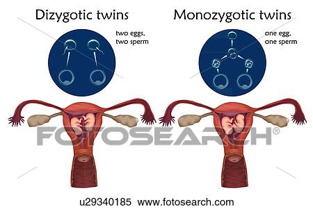 Stock Photography - Multiple pregnancy, illustration. Dizygotic and monozygotic twins comparison.. Fotosearch