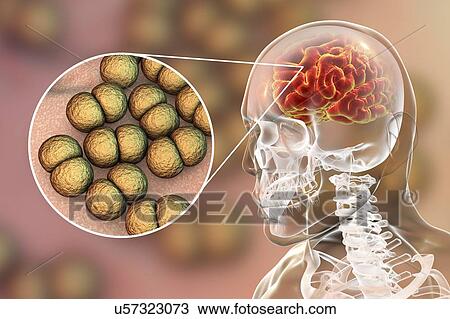 Stock Image - Neisseria meningitidis brain infection, computer illustration. N. meningitidis are gram-negative diplococci (spherical bacteria arranged in pairs), transmitted via the respiratory route. In most people they cause either asymptomatic infections or.... Fotosearch